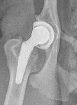 Post-op Total Hip Replacement